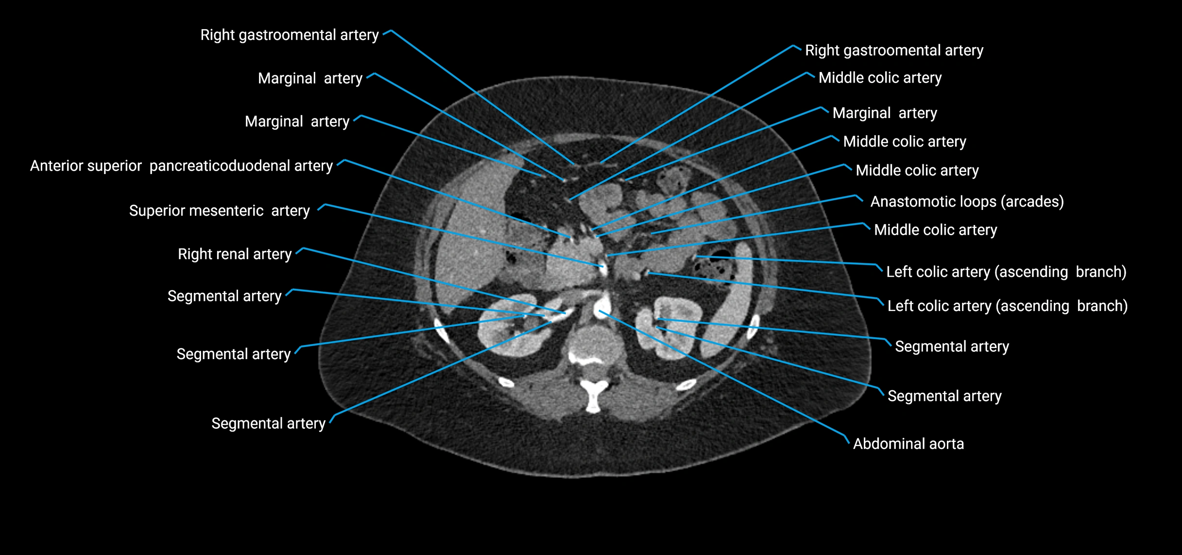 CTA abdomen axial cross sectional anatomy labelled image_68 (2).webp
